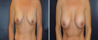 Breast-Augmentation-0068