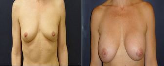 Breast-Augmentation-0075