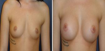 Breast-Augmentation-0059