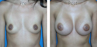 Breast-Augmentation_0032