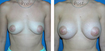 Breast-Augmentation_0034