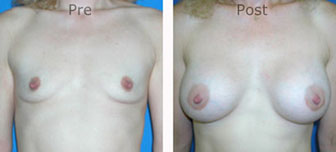 Breast-Augmentation_0037