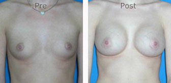 Breast-Augmentation_0040