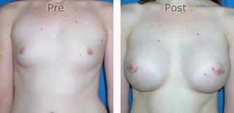 Breast-Augmentation_0041