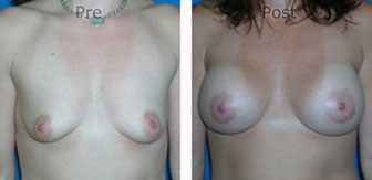 Breast-Augmentation_0046