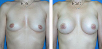 Breast-Augmentation_0055