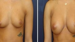 Breast-Augmentation 0060