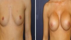 Breast-Augmentation-0062