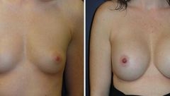 Breast-Augmentation-0065