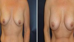 Breast-Augmentation-0068