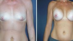 Breast-Augmentation-0069