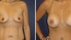 Breast-Augmentation-0070