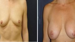 Breast-Augmentation-0075