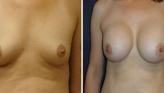 Breast-Augmentation-0076