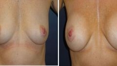 Breast-Augmentation-0080