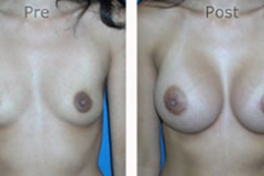 Breast-Augmentation_0032
