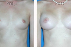 Breast-Augmentation_0042