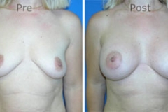 Breast-Augmentation_0043