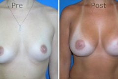 Breast-Augmentation_0044