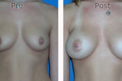 Breast-Augmentation_0048