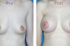 Breast-Augmentation_0054
