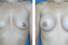 Breast-Augmentation_0055