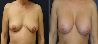 Breast-Implant_0004