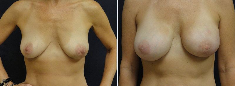 Breast Reconstruction_10129