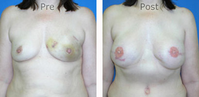 Breast-Reconstruction_0071