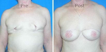 Breast-Reconstruction_0076
