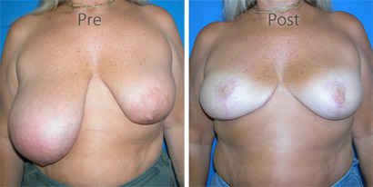 Breast-Reconstruction_0081