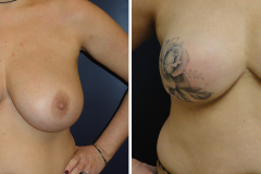 Breast Reconstruction_9948