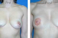 Breast-Reconstruction_0073