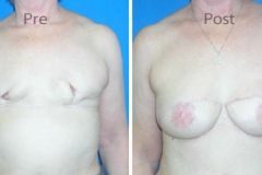 Breast-Reconstruction_0076