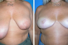 Breast-Reconstruction_0081