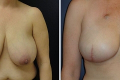 Breast-Reconstruction_0085