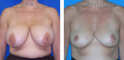 Breast-Reduction_0082