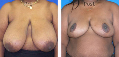Breast-Reduction_0084