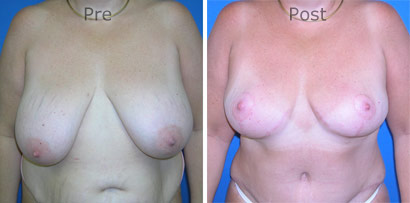 Breast-Reduction_0087