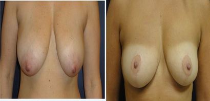 Breast-Reduction_0094