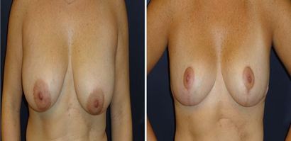 Breast-Reduction_0096