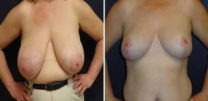 Breast_Reduction_0092