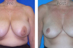 Breast-Reduction_0082