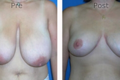 Breast-Reduction_0083