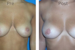 Breast-Reduction_0085