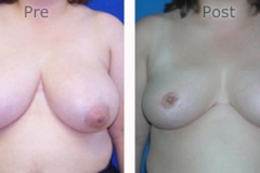Breast-Reduction_0086