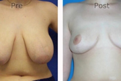 Breast-Reduction_0090