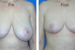 Breast-Reduction_0091