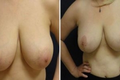 Breast-Reduction_0095