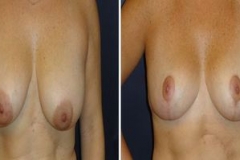 Breast-Reduction_0096